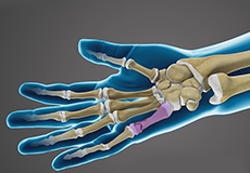 Fractures of the Hand and Fingers